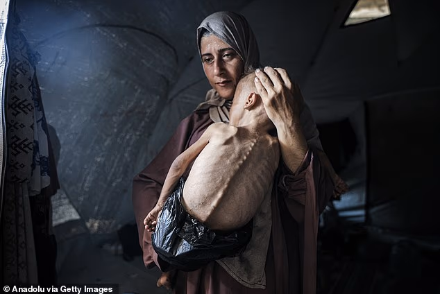 The photo of the toddler who became a symbol of hunger in Gaza: Investigation shows he suffers from genetic disease