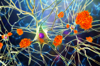 Dormant virus and head trauma: New clue in Alzheimer’s research