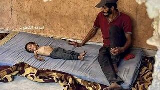 Another Gaza child, treated in Israel for genetic illness, used by Hamas as symbol of famine