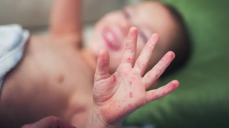 Unvaccinated toddler dies of measles