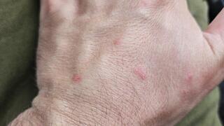 IDF soldiers in Gaza outposts report bedbug infestation: ‘Living in filth, struggling to function’