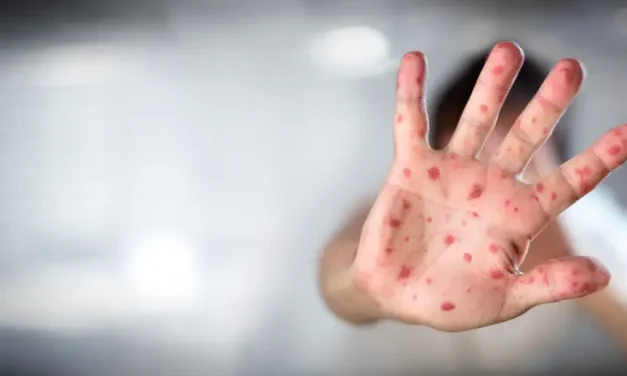 Toddler dies of measles in Jerusalem