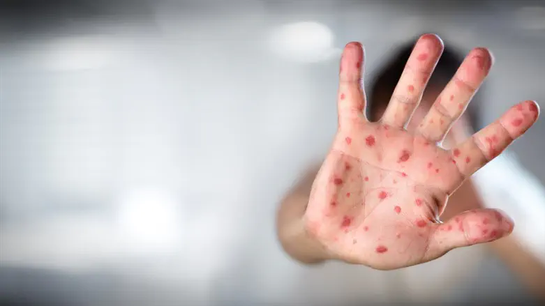 Toddler dies of measles in Jerusalem