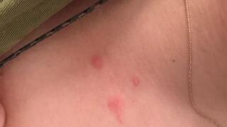 IDF soldiers sent back to base despite severe bedbug outbreak: ‘Mattresses stained with blood’
