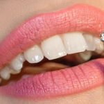 Dental bling’s hidden cost: Why that sparkly smile may come at a steep price