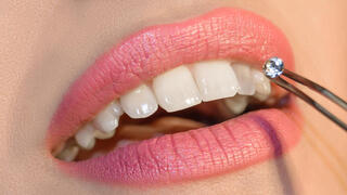Dental bling’s hidden cost: Why that sparkly smile may come at a steep price