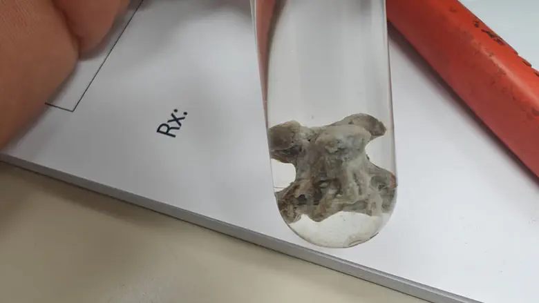 Watch: Severe pneumonia caused by drinking chicken soup