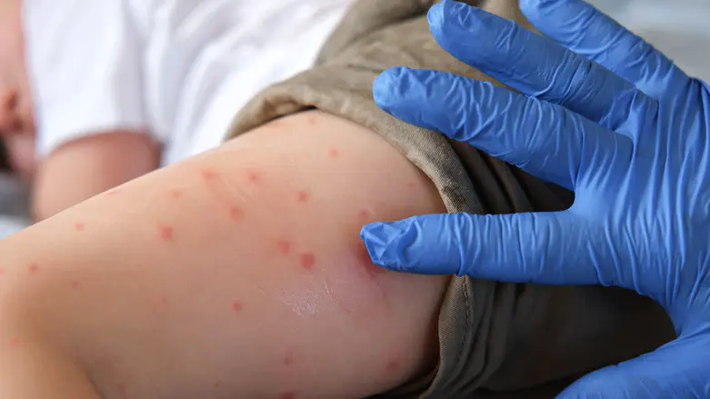 Petah Tikva joins list of measles outbreak hotspots
