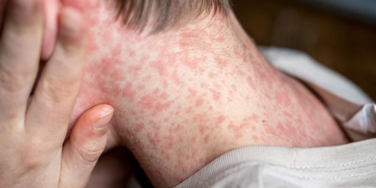Michigan announces measles outbreak after three linked cases reported