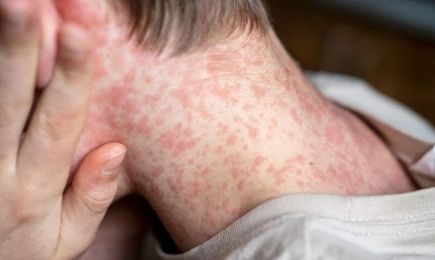 Michigan announces measles outbreak after three linked cases reported