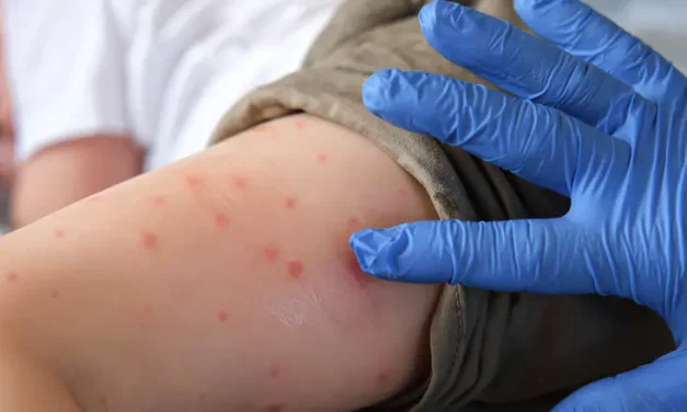 Chabad rabbi warns: Measles is a tangible risk to children’s lives