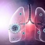 COVID-19 could increase risk of lung cancer, Israeli-led research finds