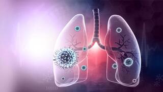 COVID-19 could increase risk of lung cancer, Israeli-led research finds
