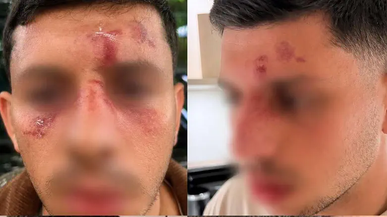 London: Young man spoke Hebrew and was attacked by masked men