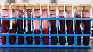 A single blood test finds more early cancers than Britain’s screening programs combined in a trial