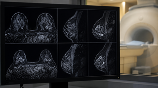 AI breakthrough could make breast cancer MRI scans faster, sharper and more accessible
