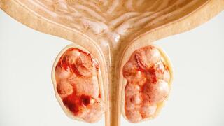 Gene editing may help the immune system find prostate cancer