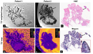 Israeli-led team wins grant to develop AI MRI for early ovarian cancer detection