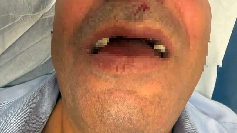 Bus driver assaulted in Jerusalem: ‘I was beaten and lost consciousness’