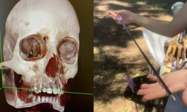 Boy survives rare skull injury after archery camp accident