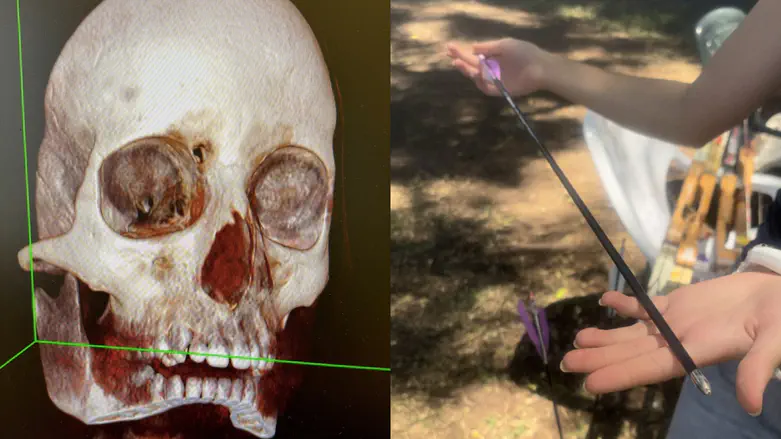 Boy survives rare skull injury after archery camp accident
