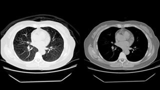 AI spots esophageal cancer on CT scans months before diagnosis