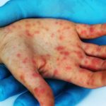 New York declares first US measles disaster emergency since 2025 surge
