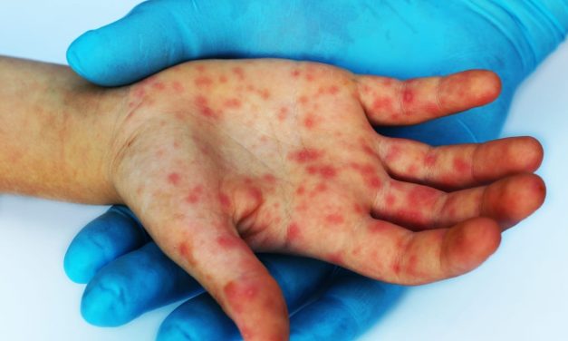 New York declares first US measles disaster emergency since 2025 surge