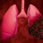 Lung cancer breakthrough: drug combination cuts death risk by 58% in major trial