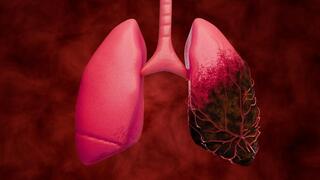 Lung cancer breakthrough: drug combination cuts death risk by 58% in major trial